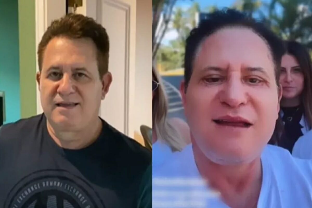 Cantor Marrone antes e depois da cirurgia no rosto (Foto: Reprodução/Instagram)