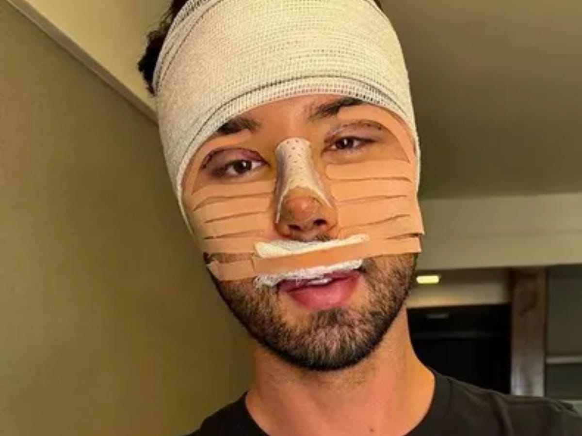 Rico Melquiades mostra resultado de cirurgia plástica que custou R