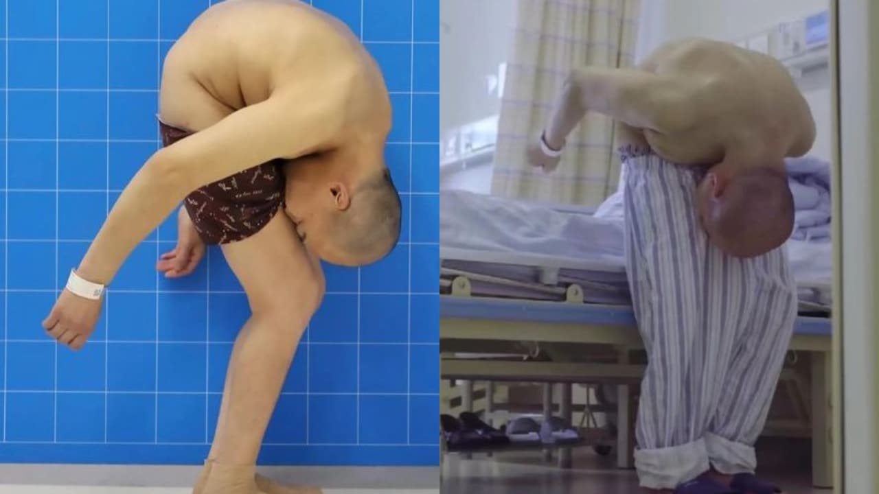 “Homem dobrado” retoma movimentos normais após 28 anos com coluna curvada